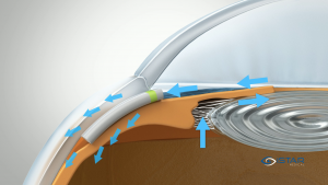 MINIject implanted in suprachoroidal space