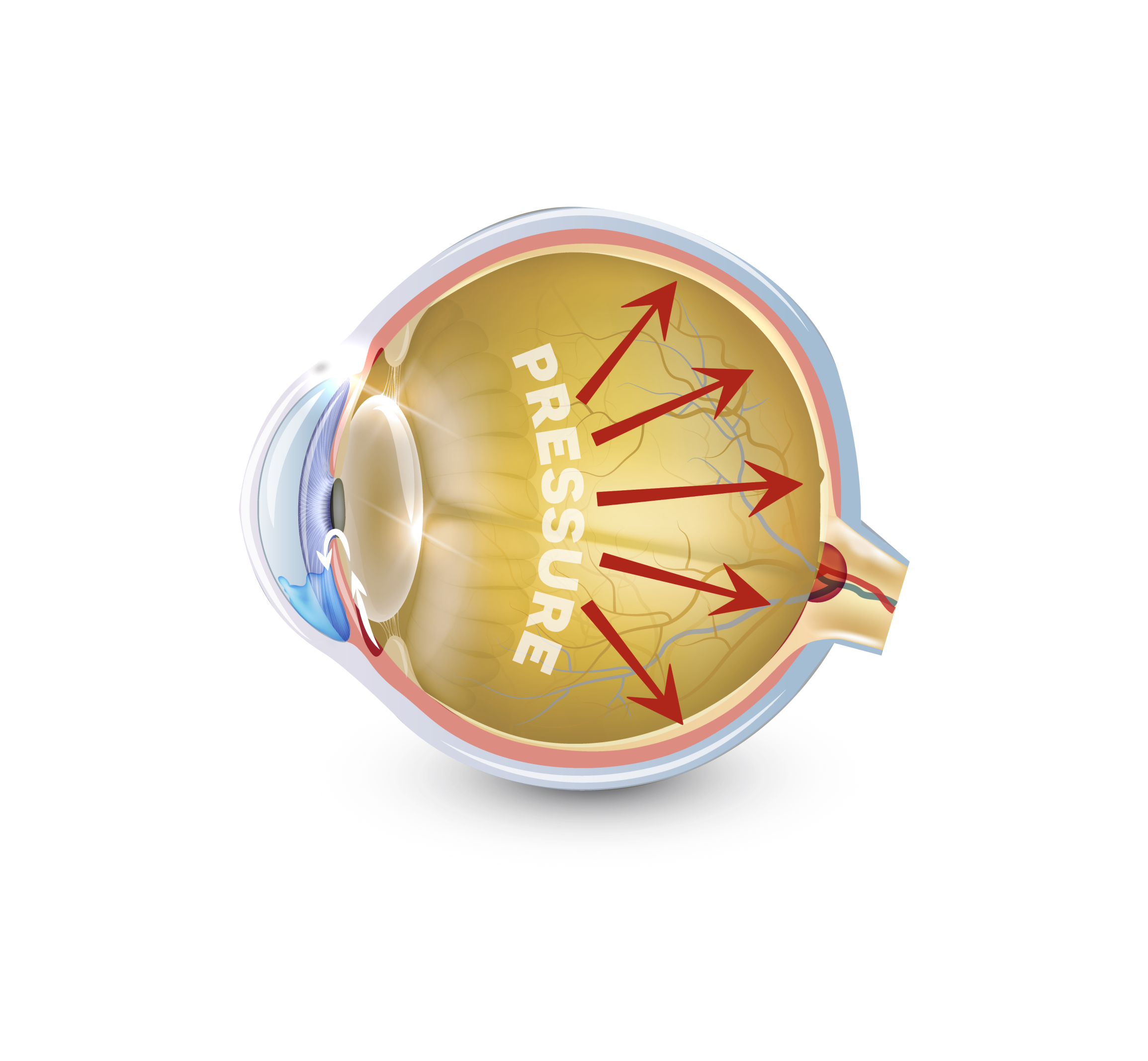 Glaucoma eye with pressure increase
