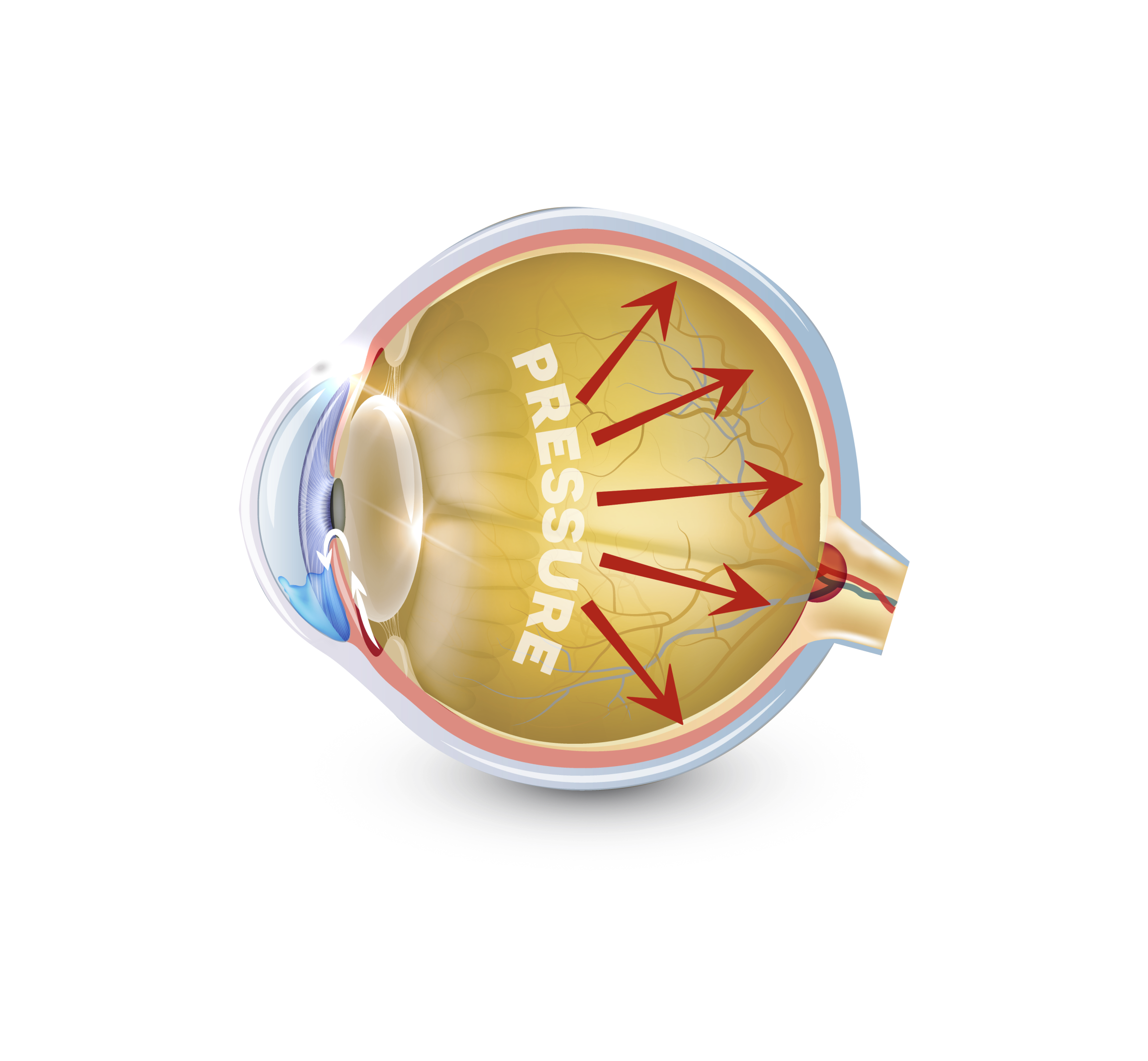 Glaucoma eye with pressure increase